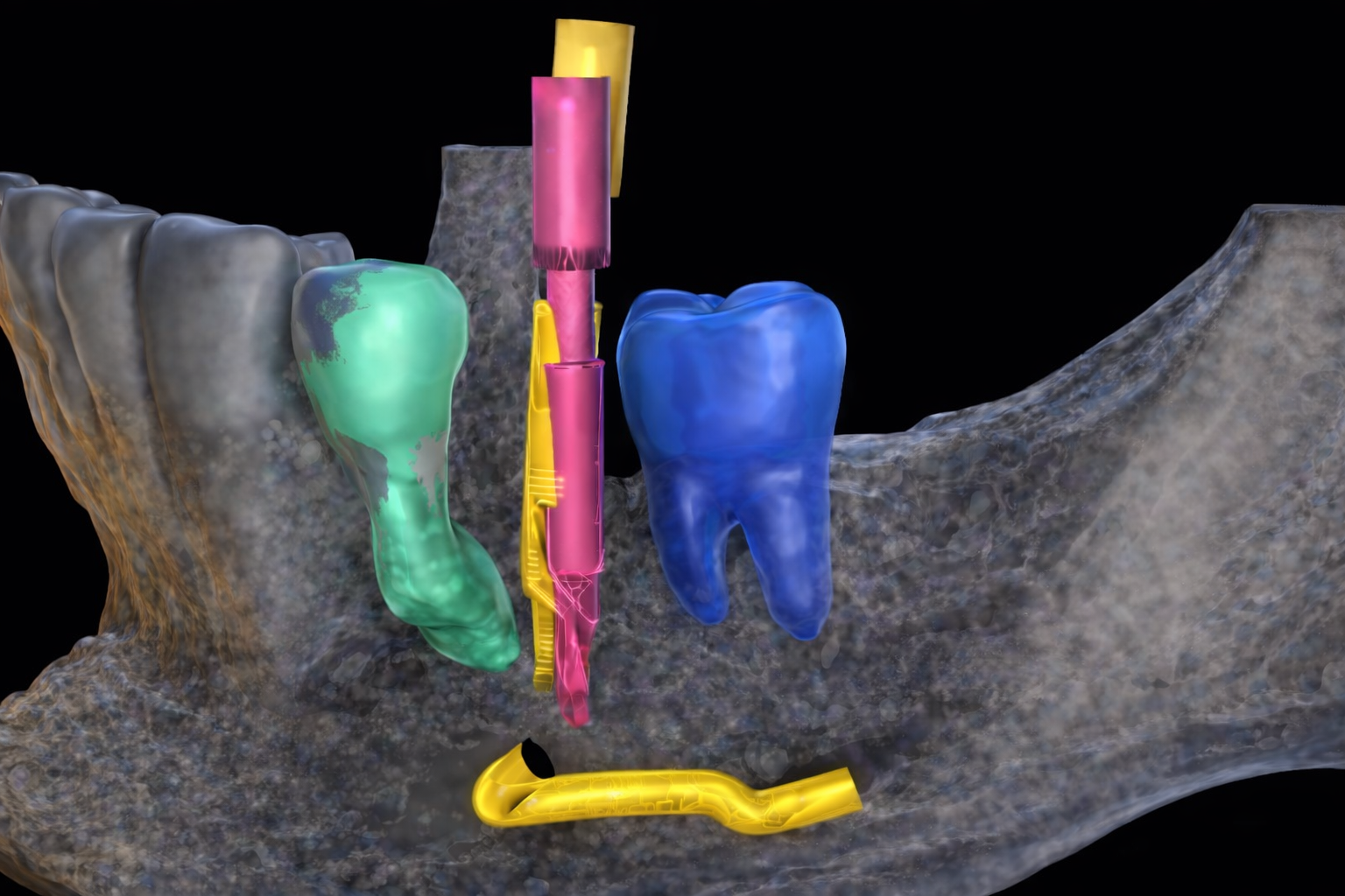A novel high-resolution technology under development at the College of Dentistry enables real-time visualization of surgical instrumentation, helping dentists improve the accuracy of dental implant placement. Surgical drills (yellow and pink) are digitally scanned during the operative procedure and integrated into a virtual patient reconstruction to determine their position relative to neighboring teeth (green and blue) and nearby nerves (bottom yellow).